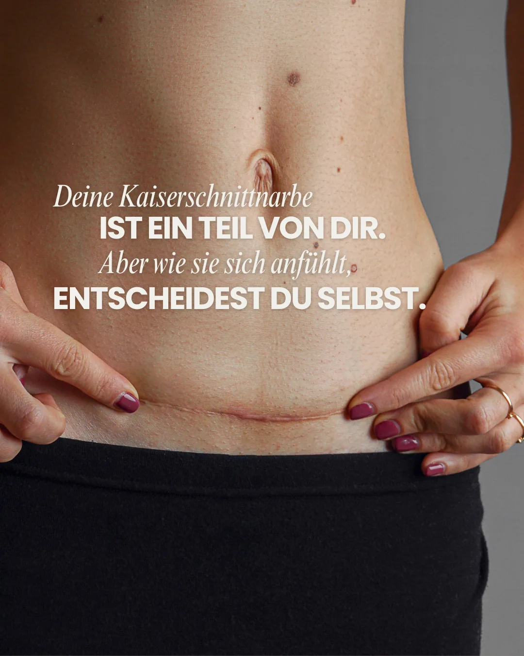 Ein Kaiserschnitt ist ein Zeichen für ein Wunder. Trotzdem fühlen sich einige Frauen durch ihre verbleibende Narbe unwohl.⁠
Zum Glück gibt es Möglichkeiten, sie verblassen zu lassen und das Wohlbefinden wieder zu steigern. 🌸⁠
⁠
Vereinbare jetzt einen Beratungstermin und erfahre, wie wir dir und deiner Haut etwas Gutes tun können. 📅⁠
⁠
#SchöneHaut #Kaiserschnittnarbe #Narbenbehandlung⁠
⁠
⁠
Mit Unterstützung von KI erstellt.