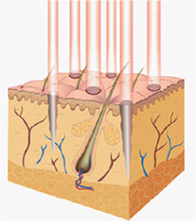 Mikrolaserstrahlen auf Hautoberfläche