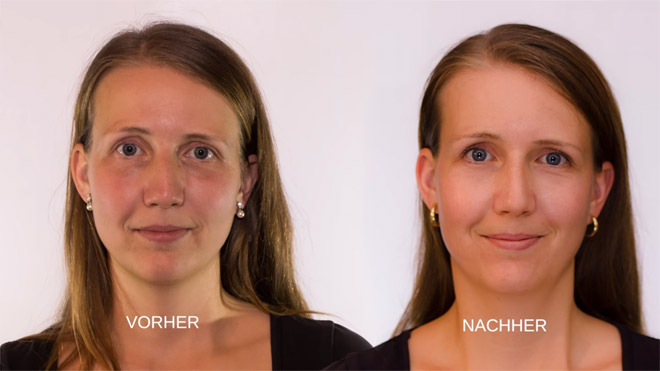 Reduzierung der Schatten bei ausgeprägten Augenringen