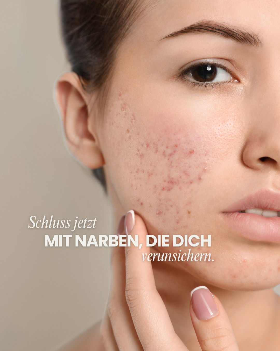 Narben sind etwas ganz Natürliches – und trotzdem wünschen wir uns manchmal, dass sie weniger sichtbar sind. Genau dabei unterstützen wir dich. 🤍⁠
Der erste Schritt ist eine persönliche Beratung. Vereinbare gern jetzt deinen Termin. 📍⁠
⁠
#SchöneHaut #Narbenbehandlung  #Hautbild