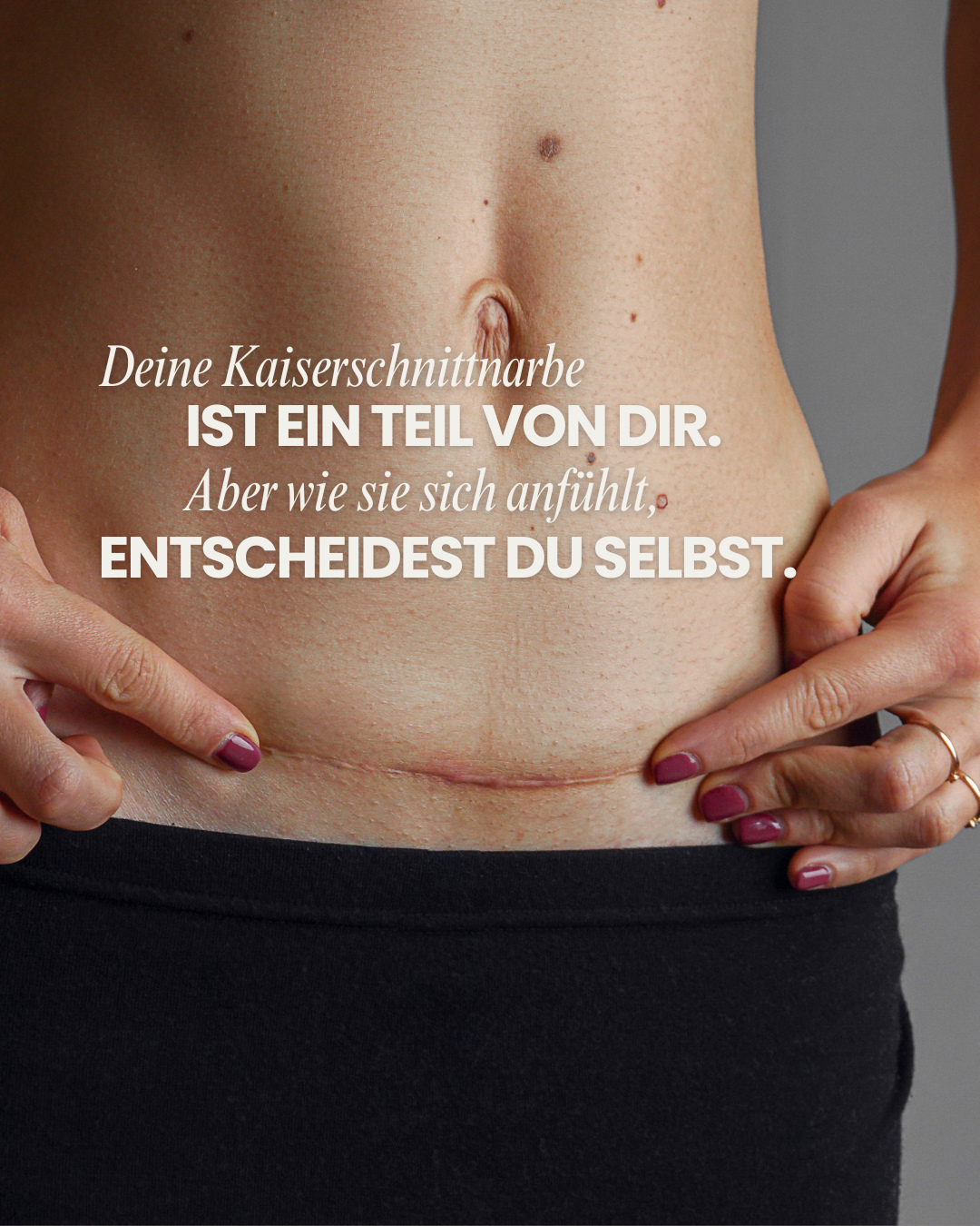 Ein Kaiserschnitt ist ein Zeichen für ein Wunder. Trotzdem fühlen sich einige Frauen durch ihre verbleibende Narbe unwohl.
Zum Glück gibt es Möglichkeiten, sie verblassen zu lassen und das Wohlbefinden wieder zu steigern. 🌸
Vereinbare jetzt einen Beratungstermin und erfahre, wie wir dir und deiner Haut etwas Gutes tun können. 📅
#SchöneHaut #Kaiserschnittnarbe #Narbenbehandlung
Mit Unterstützung von KI erstellt.